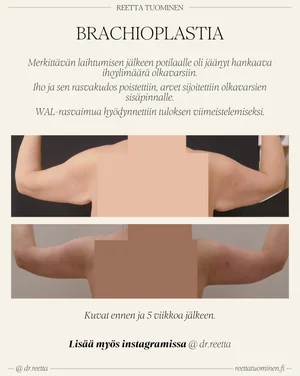 Olkavarsien Allien Leikkaus Brachioplastia Allit Pois Reetta olkavarsien-allien-leikkaus-brachioplastia-allit-pois-reetta