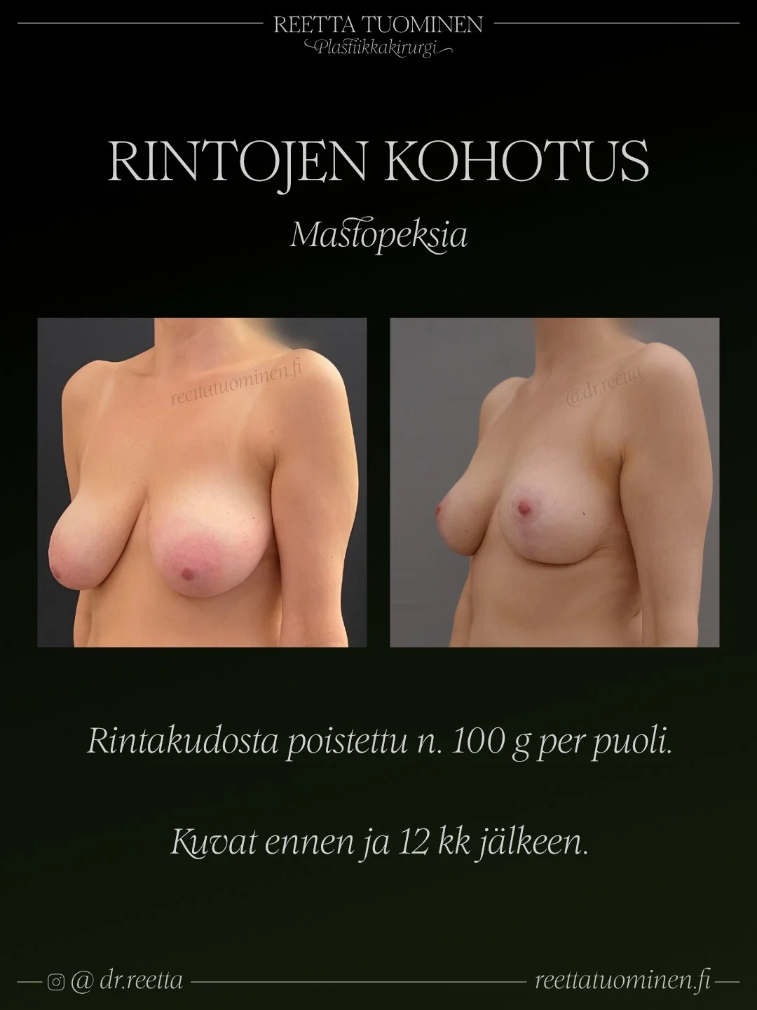 Rintojen kohotus ennen ja jälkeen. Nännit on pienennetty, pieni määrä kudosta poistettu.
