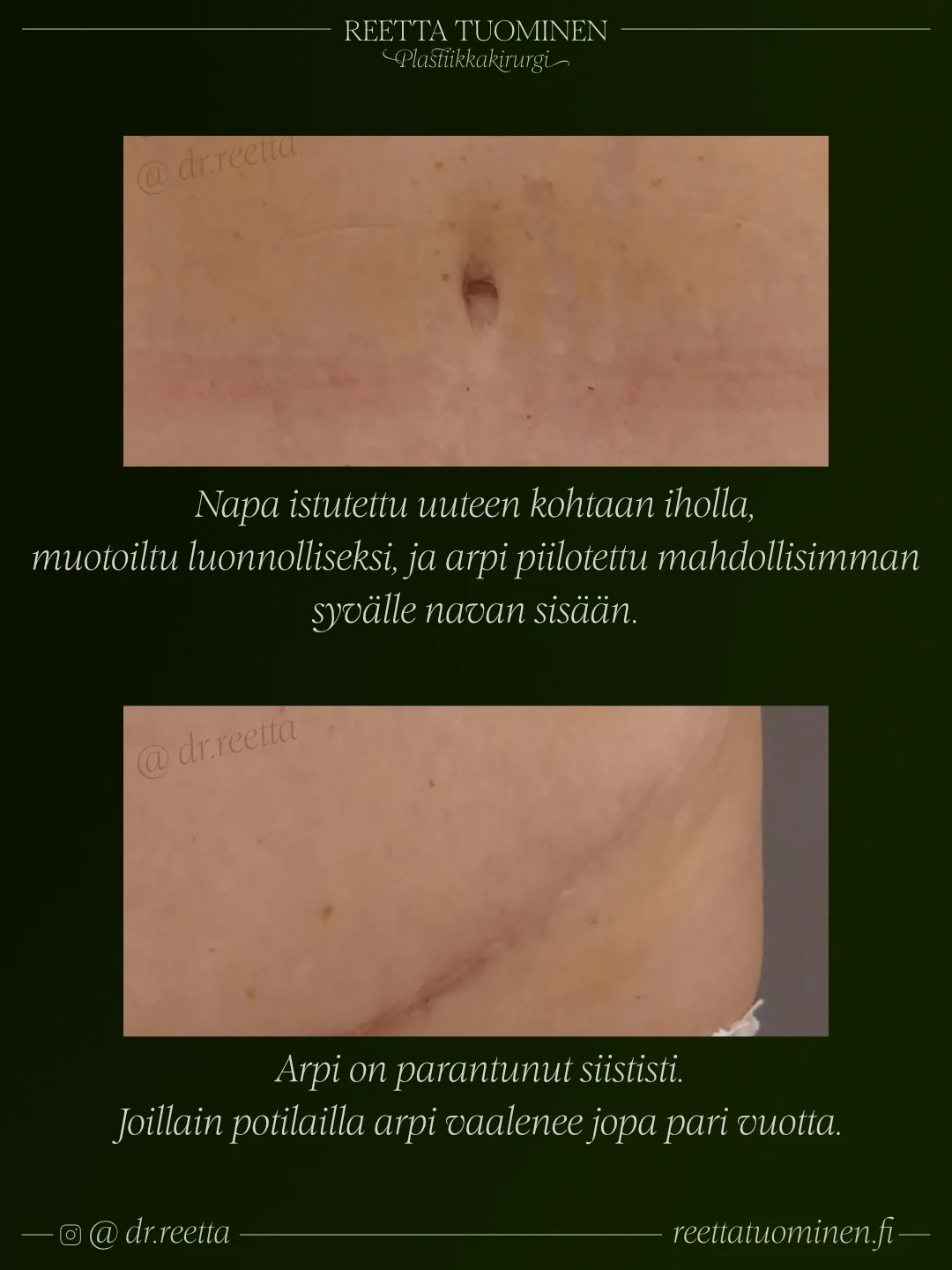 Vatsalihasten erkauman leikkaus ja HELP-abdominoplastia