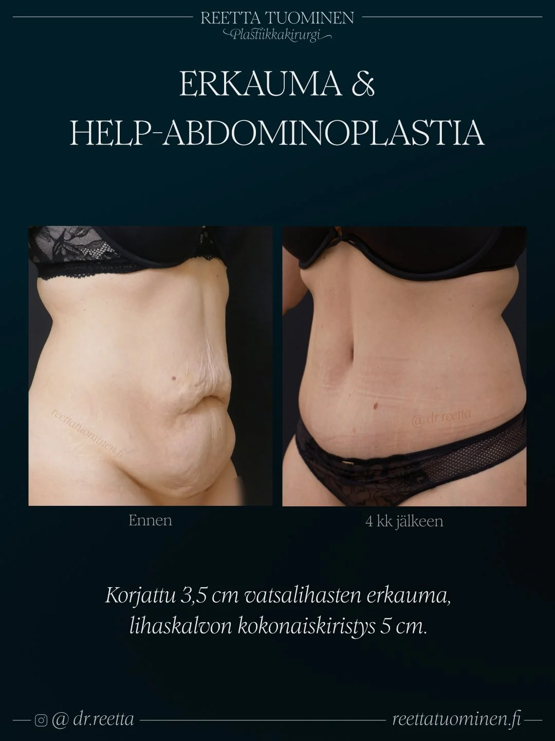 Vatsalihasten erkauman leikkaus ja rasvaimu