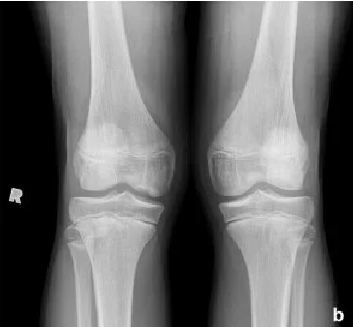 X-ray of two knees showing bones and joints.
