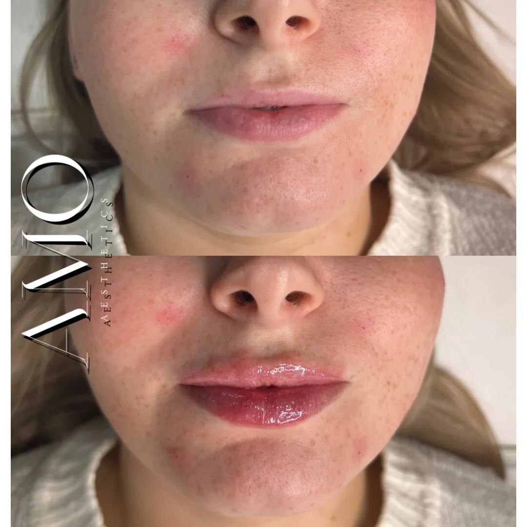 She walked in nervous, excited, and ready &mdash; a whole year of &lsquo;maybe one day&rsquo; leading to this moment.

0.7ml later&hellip; the most beautiful, natural first-time lips. 💗

Sometimes the slowest decisions become the best ones. 

#Petts