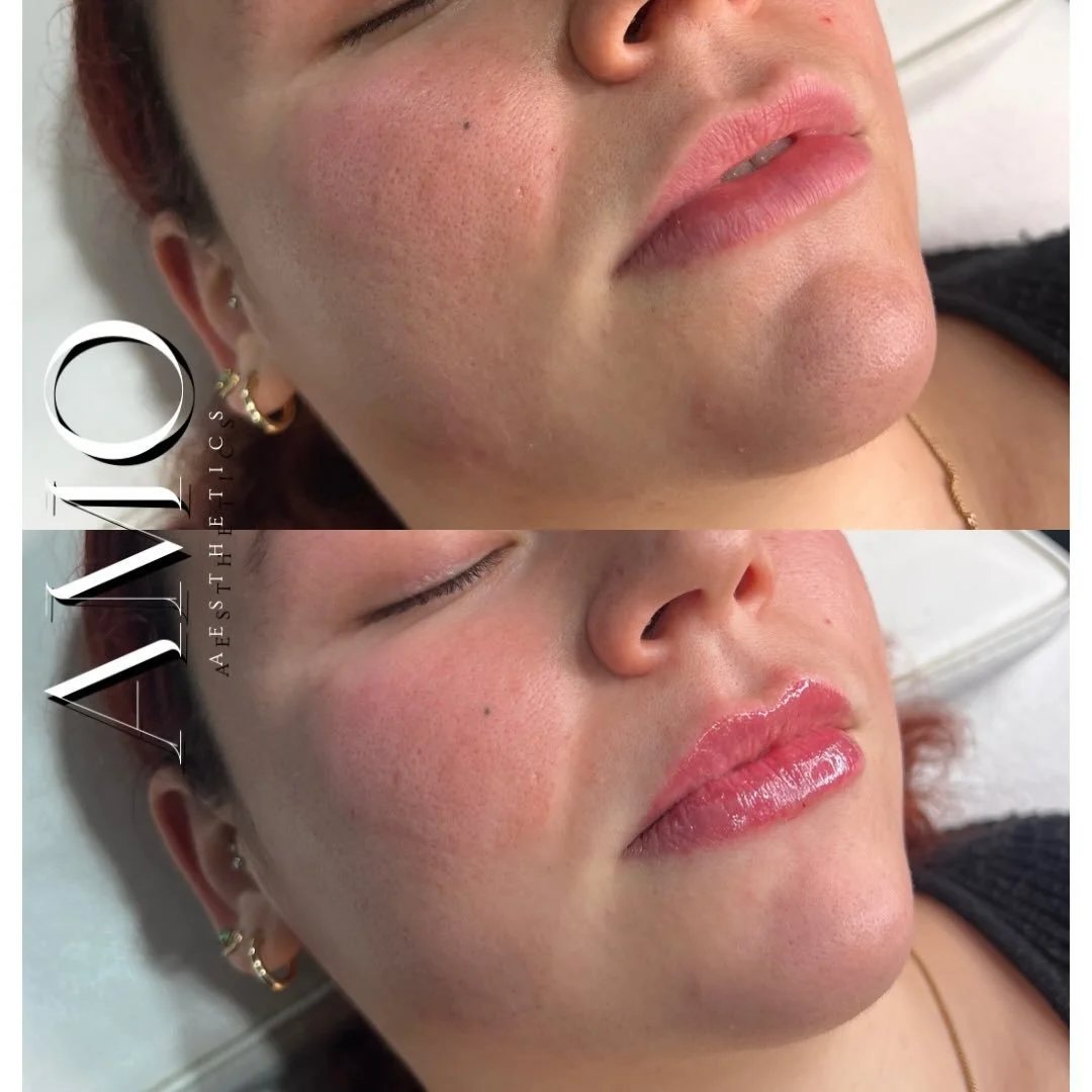 Natural but enhanced is what I love doing the most 😍😍

#PettsWoodAesthetics #PettsWoodBeauty #OrpingtonAesthetics #BromleyAesthetics #ChislehurstBeauty #BickleyAesthetics #SidcupAesthetics #BeckenhamBeauty #LocksbottomAesthetics #KentAesthetics #Li