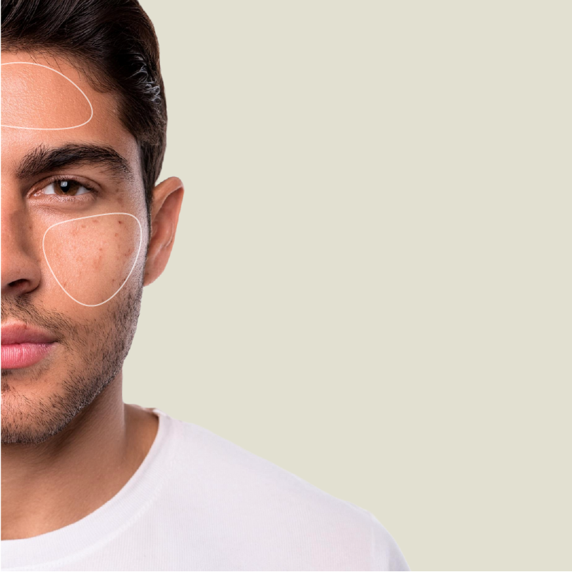 Peeling químico Image.png