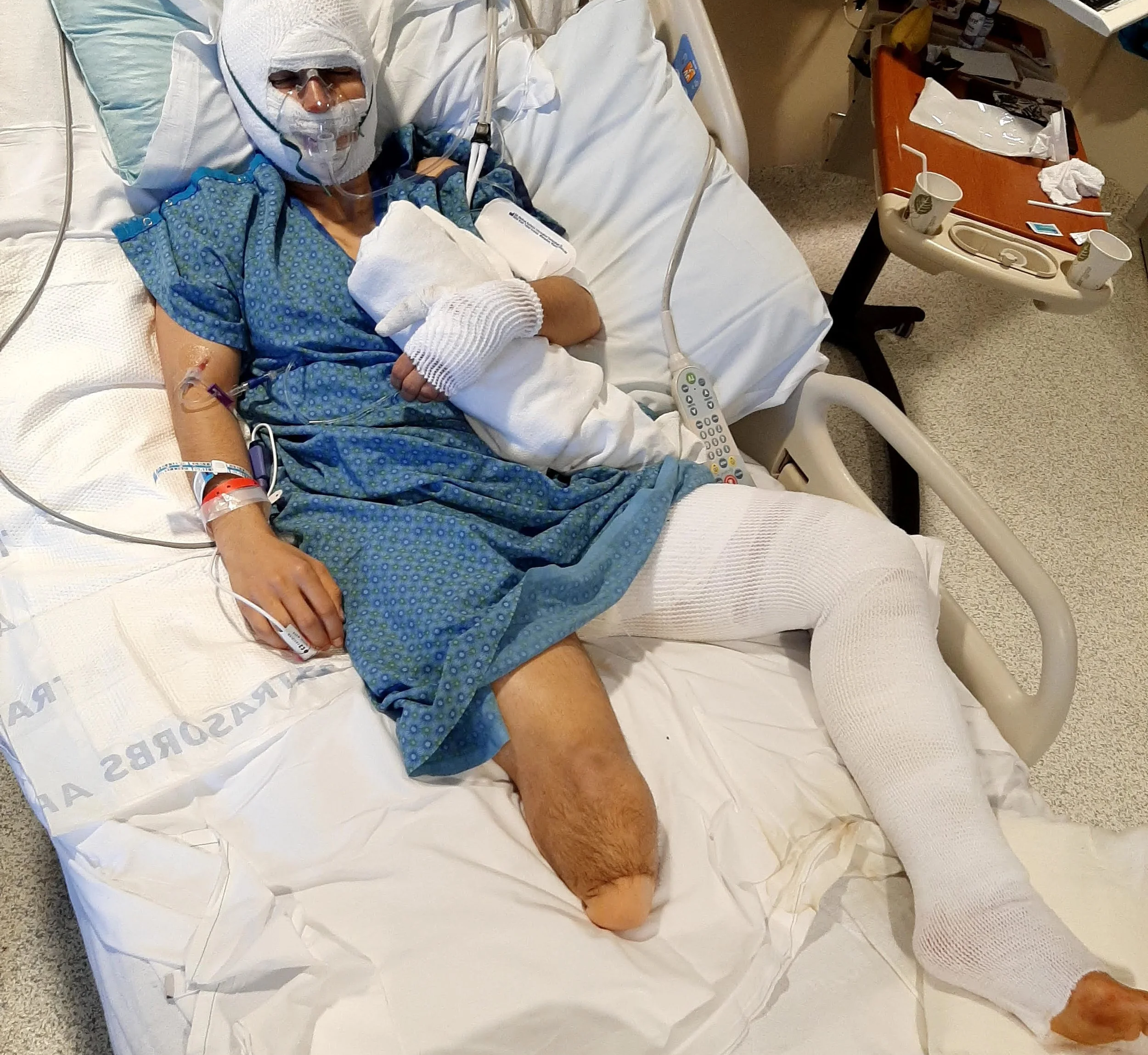 Angelina covered in bandages in a hospital bed. Burnt head to toe from a kitchen fire.