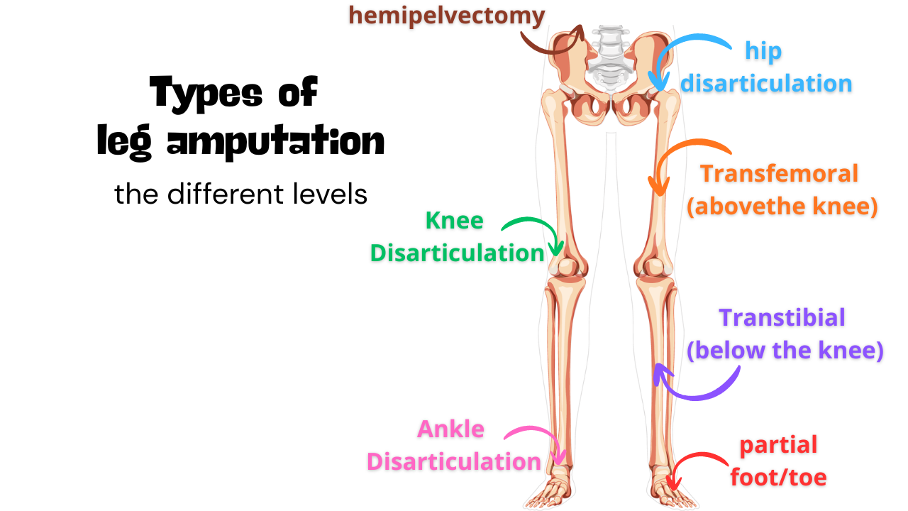 Types of Leg Amputation: Below-Knee, Above-Knee &amp; Other Levels Explained