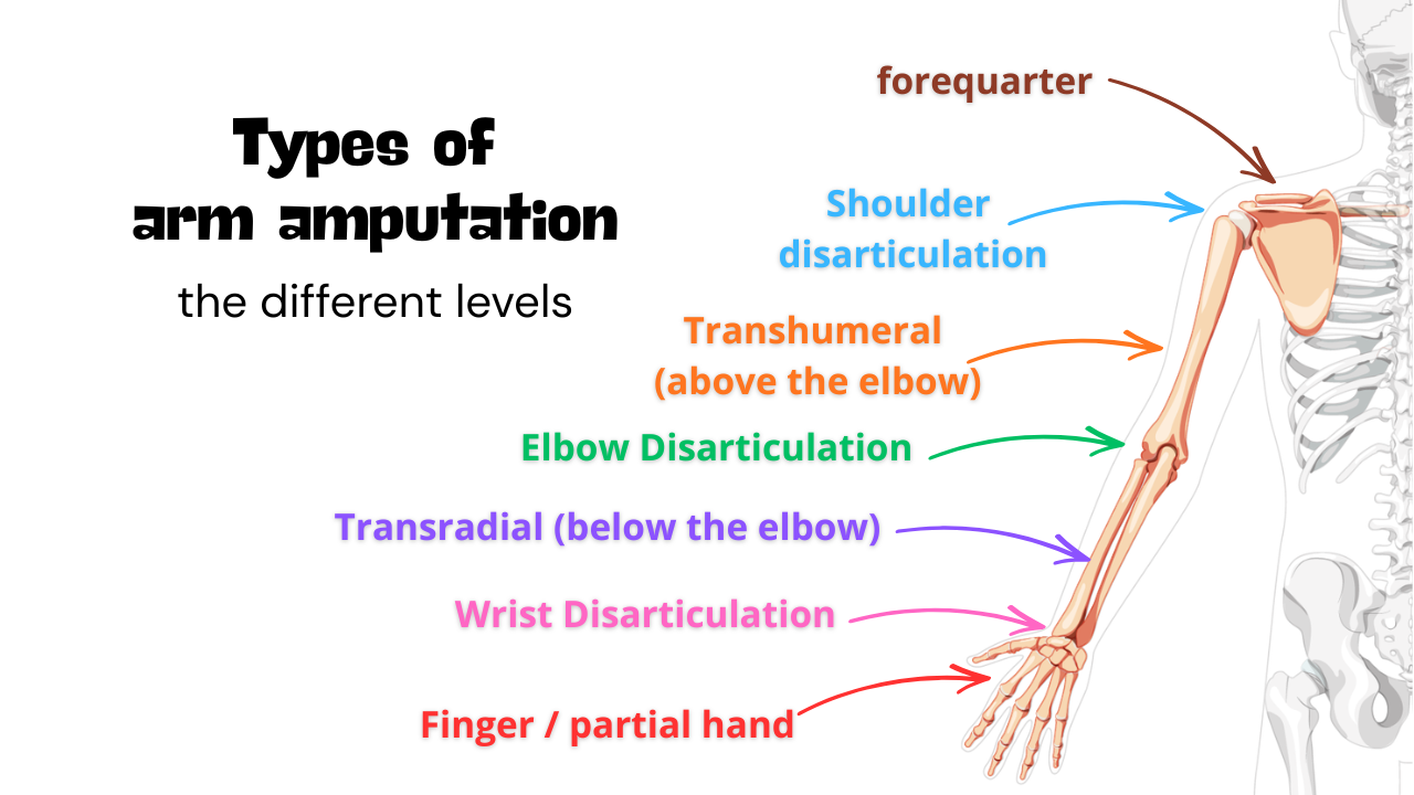 Types of Arm Amputation: Levels, Differences, and What They Mean