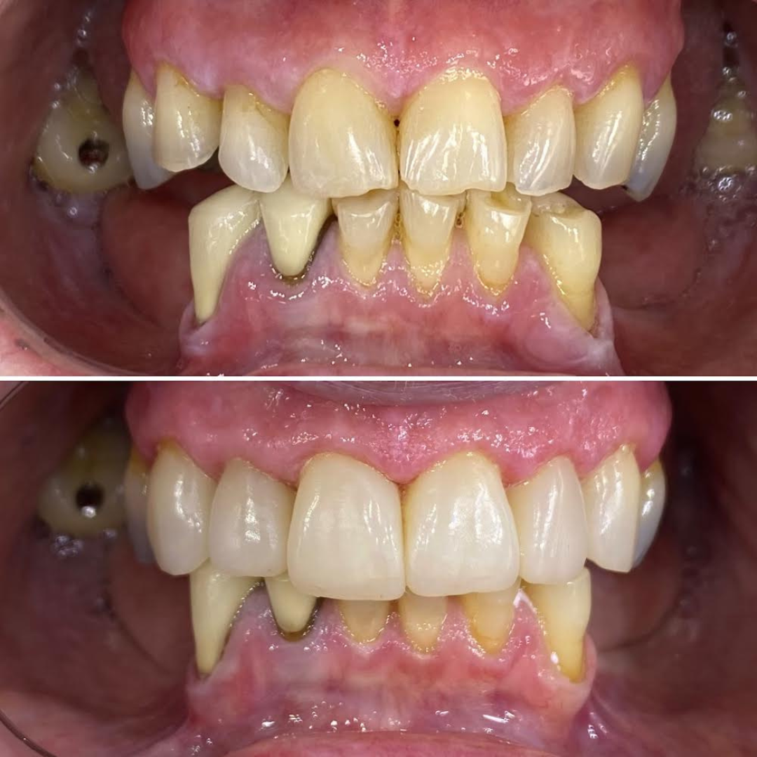 Injection moulding 6 teeth