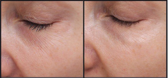 Nanosoft eye enhancement after 1 session
