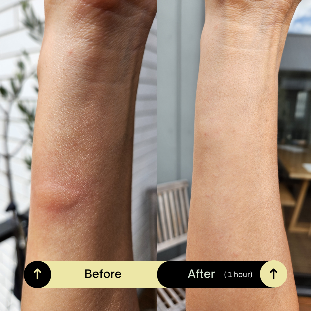 Itchy bite arm.png