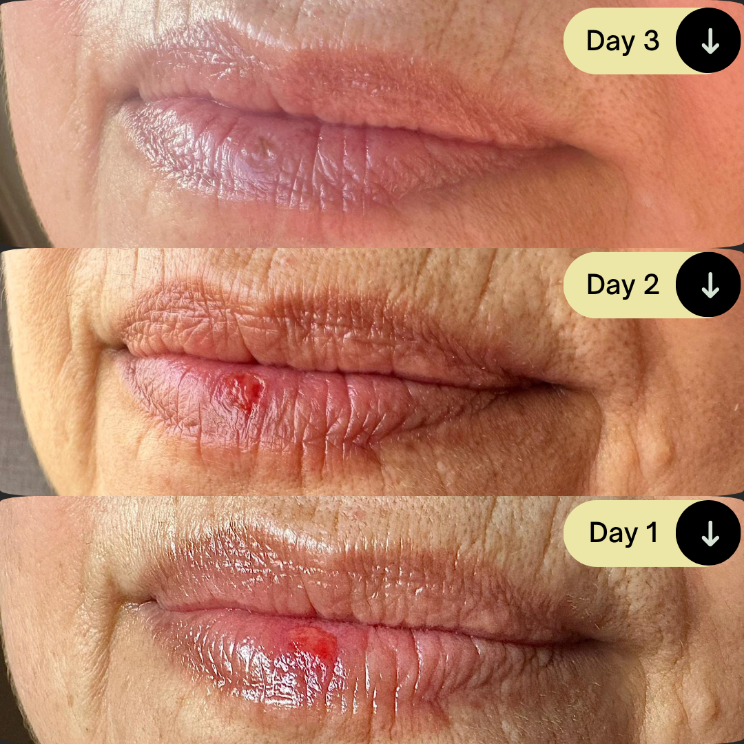  Cold sore before +after.png