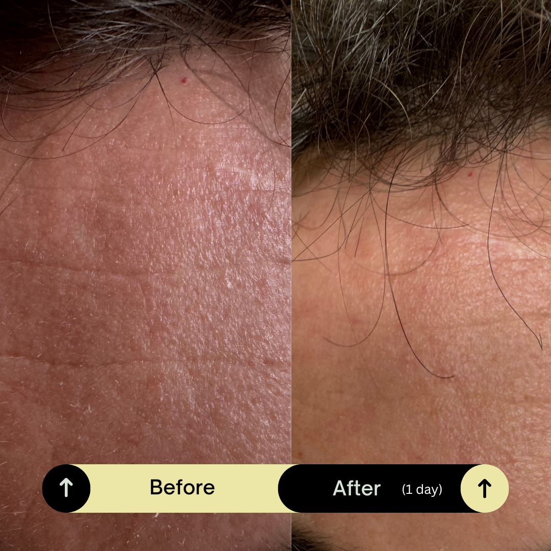  Inflamed forehead.png