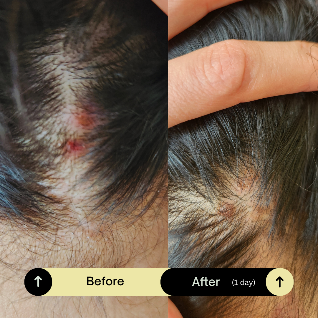  Psoraisis in back of head.png