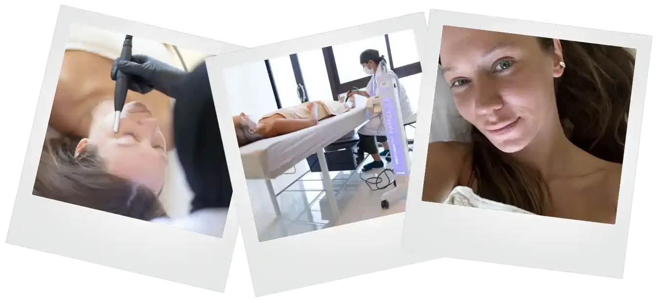 TSW CAP Treatment in Bali