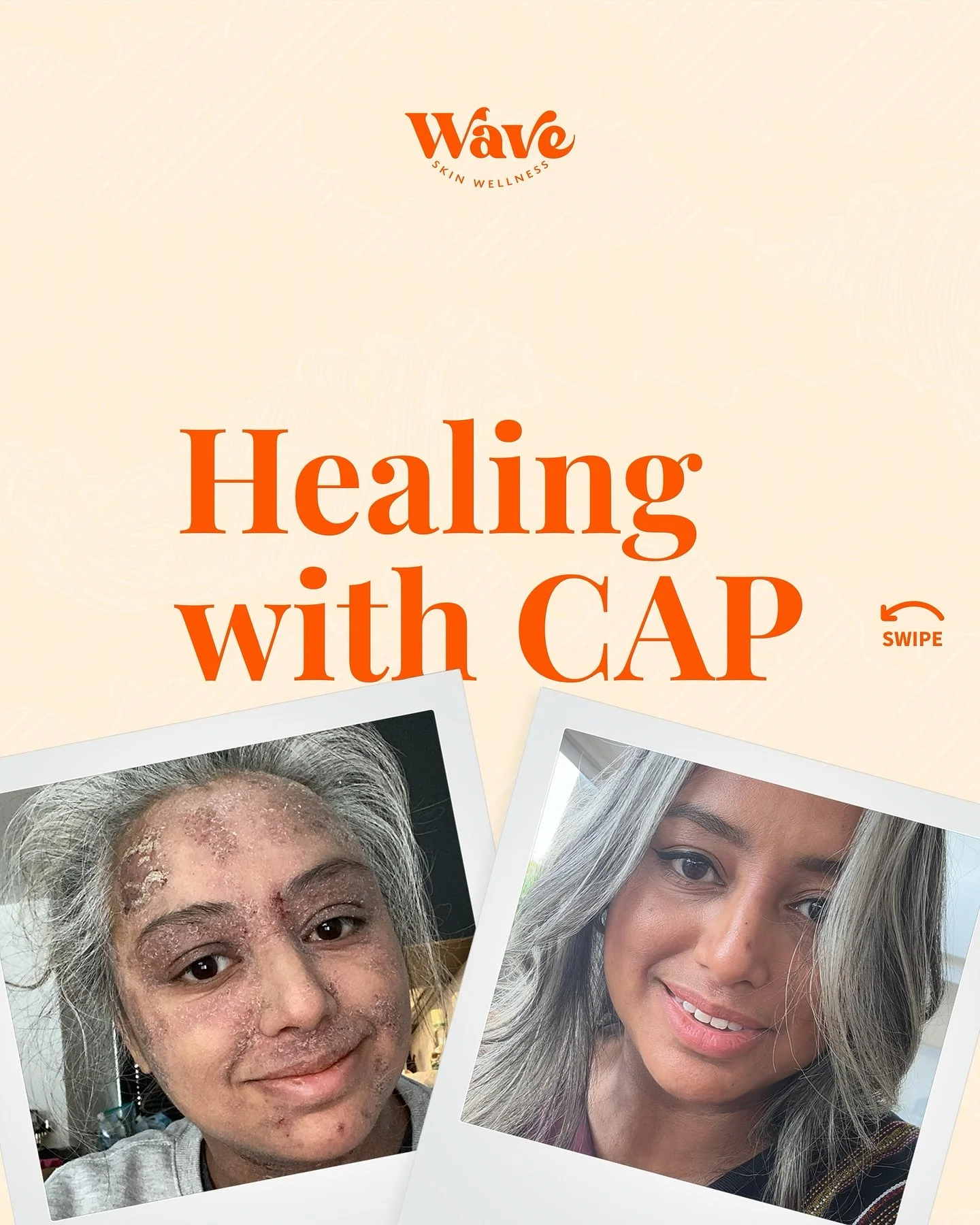 After years of topical steroid use, my skin took a turn for the worse and I ended up with full blown Topical Steroid Withdrawal symptoms.

Topical steroids had suppressed my cell function and thinned my skin to the extent that I was suffering from pa