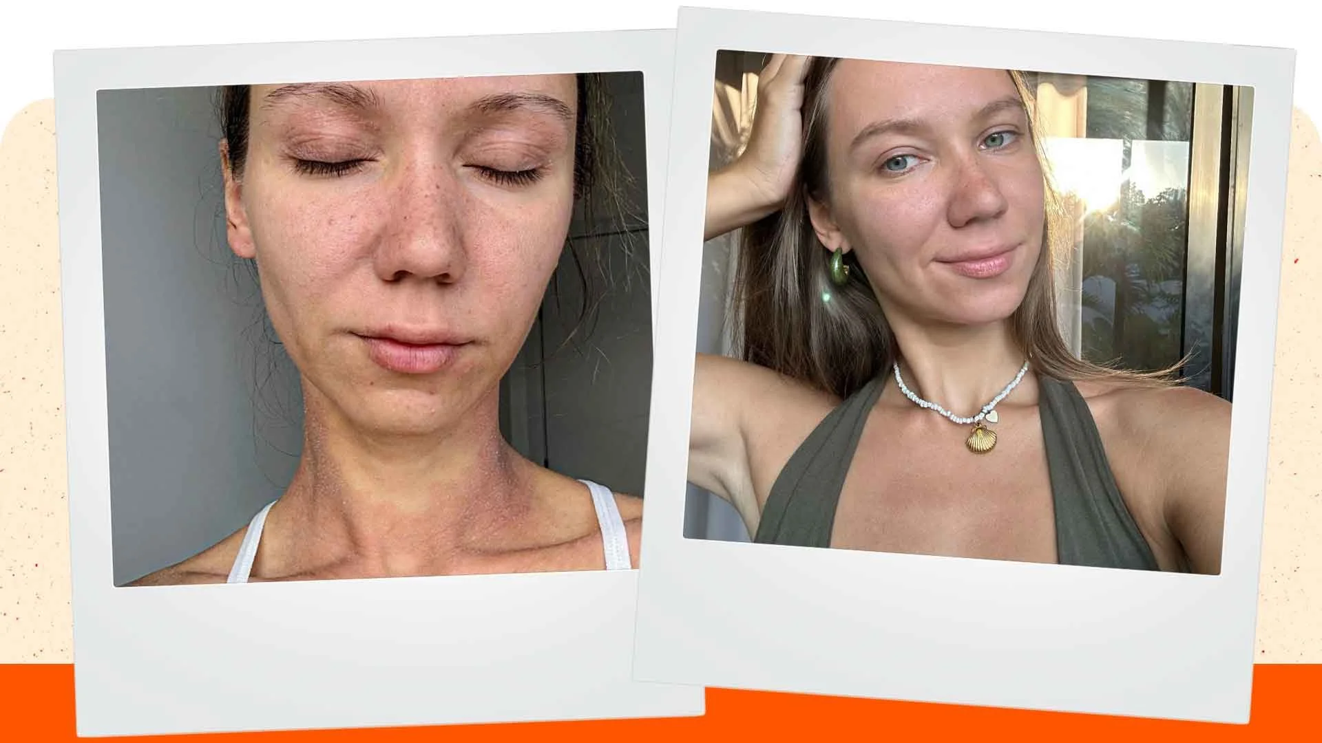 Young female Maria before and after TSW, Fungal and CAP Treatment