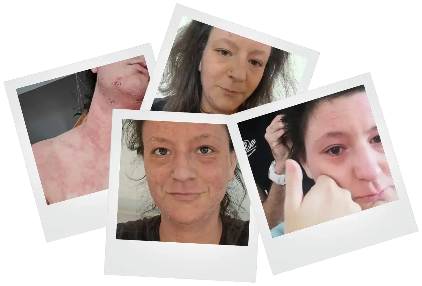 TSW Recovery Journey of Annina during medical CAP Therapy