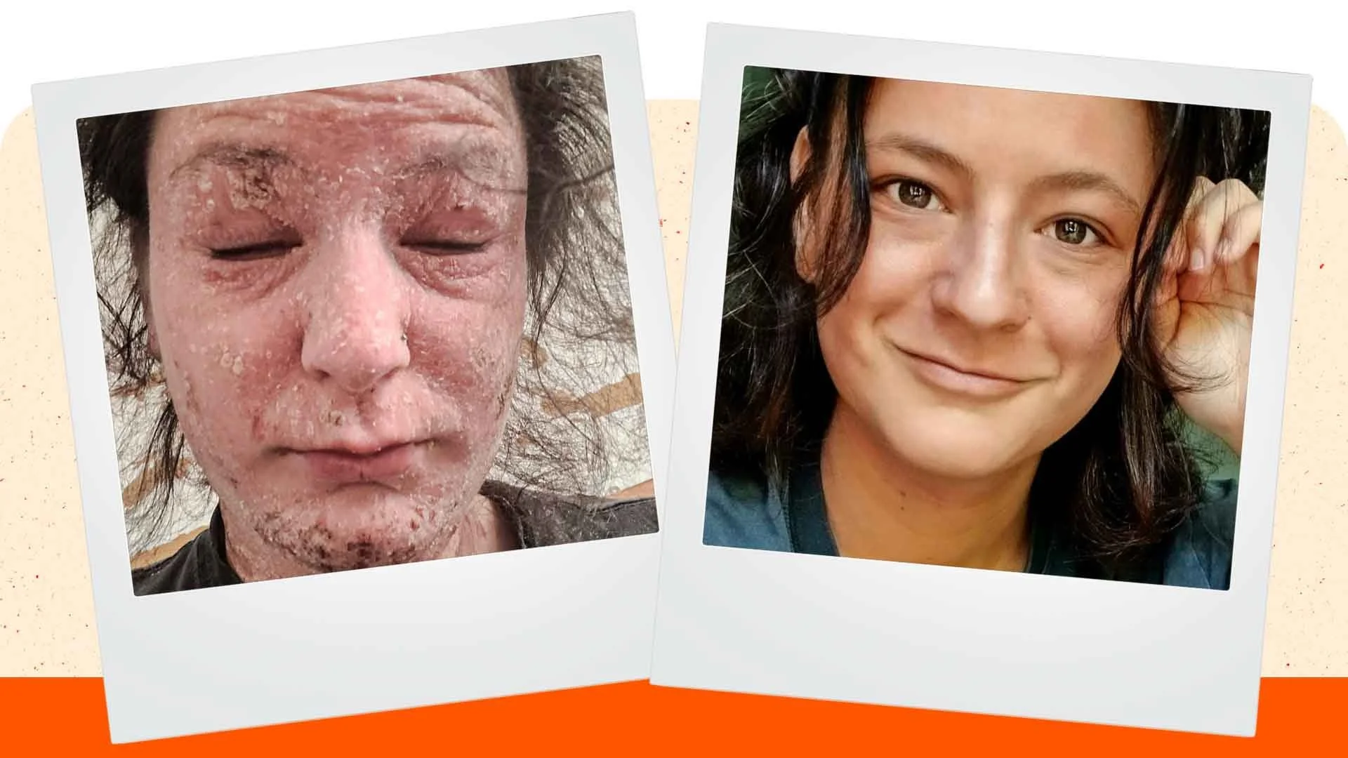 Young female Annina before and after TSW with CAP