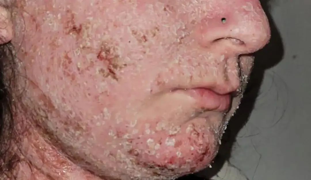 Annina's TSW Journey, Flaking and Wounds