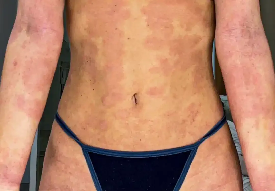 TSW Symptoms, red skin, fungal, flaking, oozing