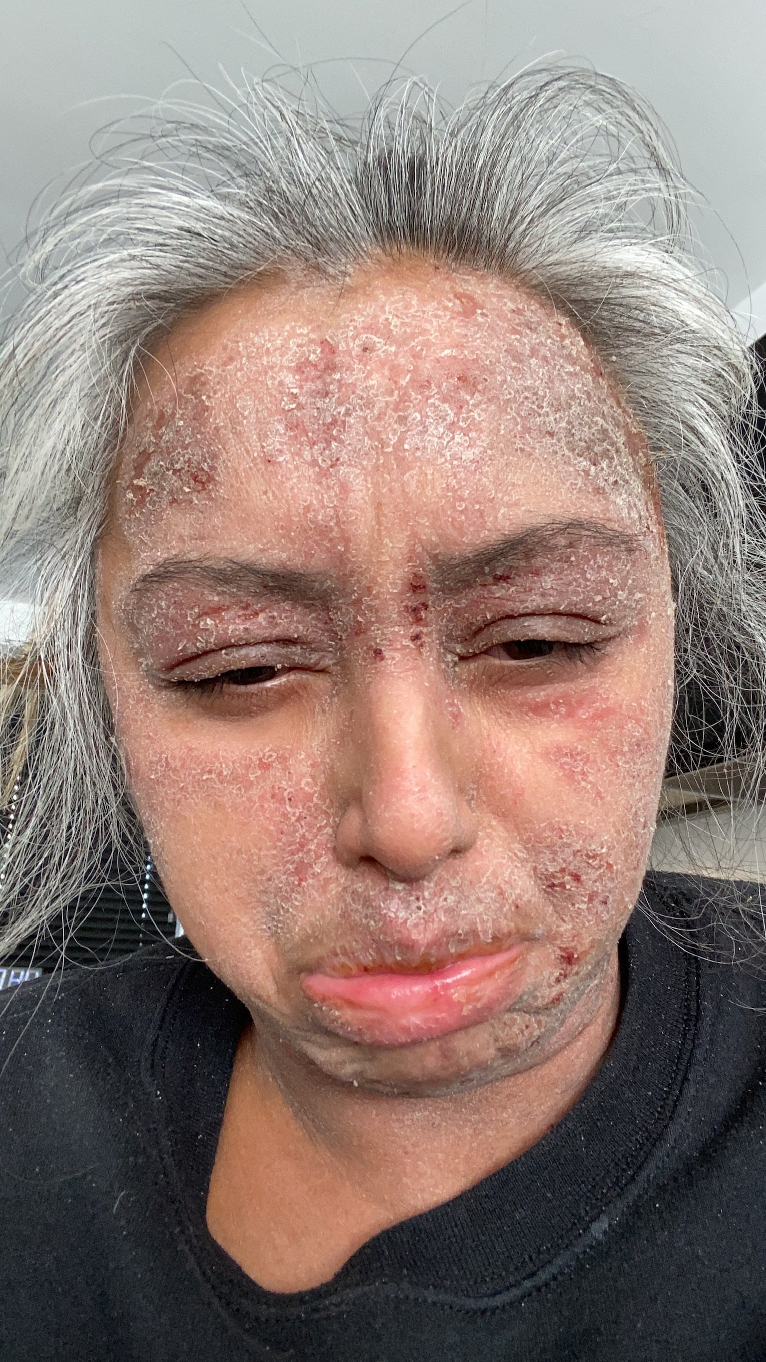 TSW | Red Skin Syndrome symptoms before CAP Clinic