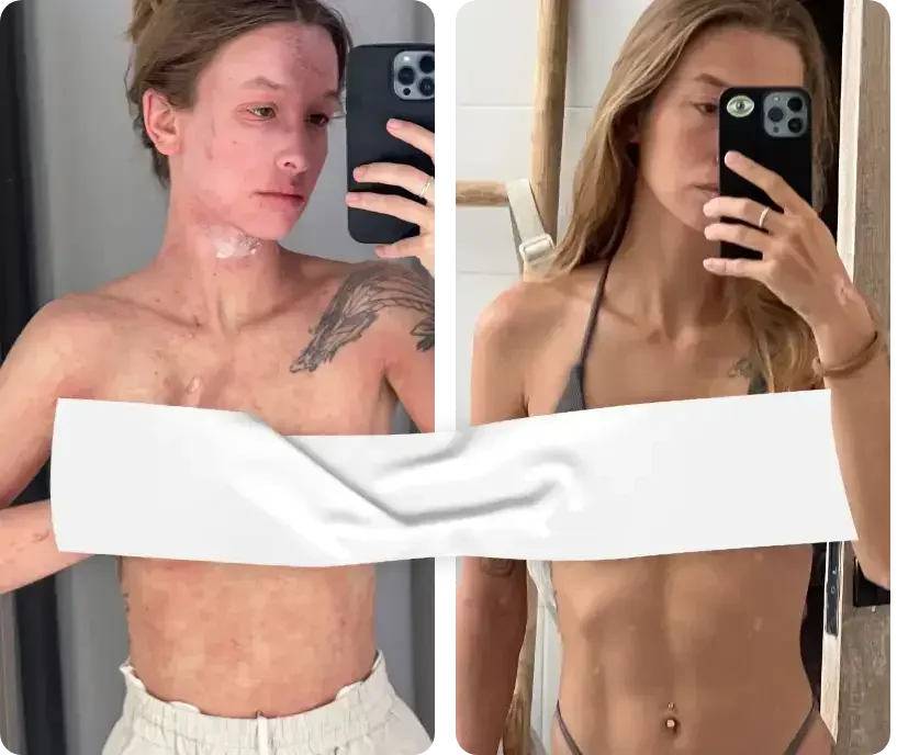 Before and After TSW and Red Skin Syndrome with CAP Therapy and Lifestyle changes