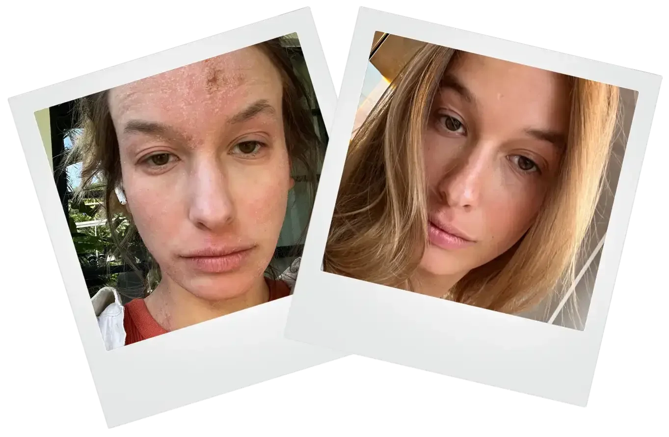 Anna's TSW Before and After image at Wave Skin Wellness TSW Clinic