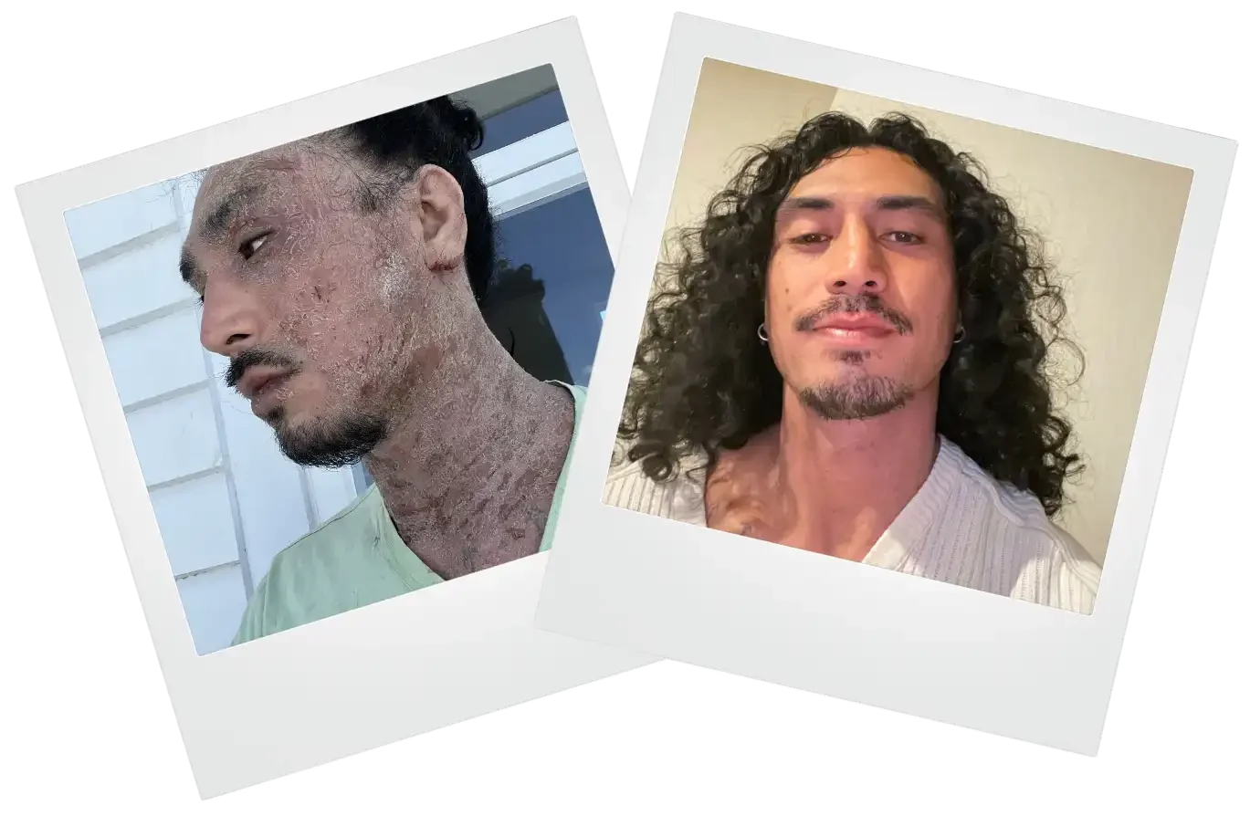 Before and after medical CAP treatment in Thailand and Bali