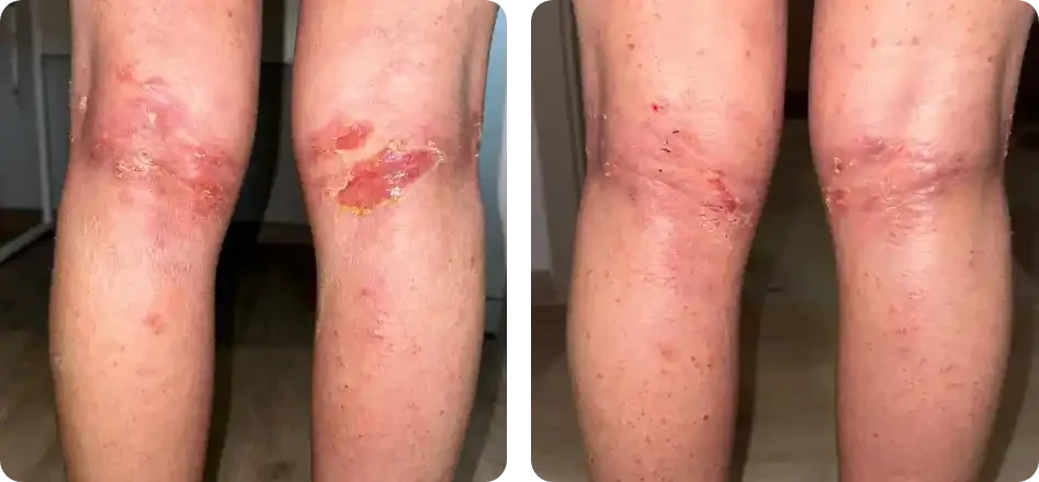 Back of the legs with TSW irritant exposure in a cafe in Bangkok, Thailand