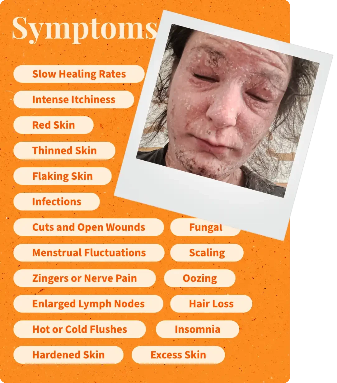 TSW | Red Skin Syndrome Symptoms card of Annina