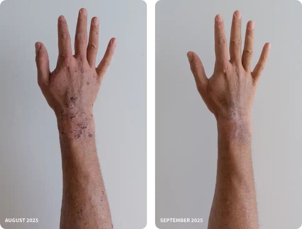 Before and after picture of a hand on the left side wounds and crusts and the right side a healed version with minor scars and cleared skin