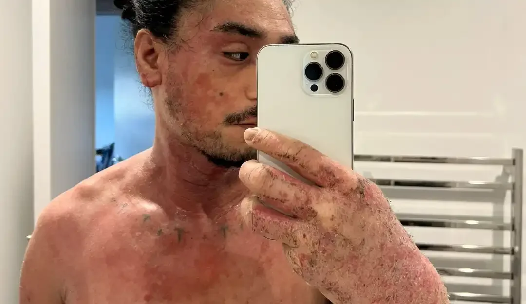 Person with severe TSW, dry flaking skin, red burning skin