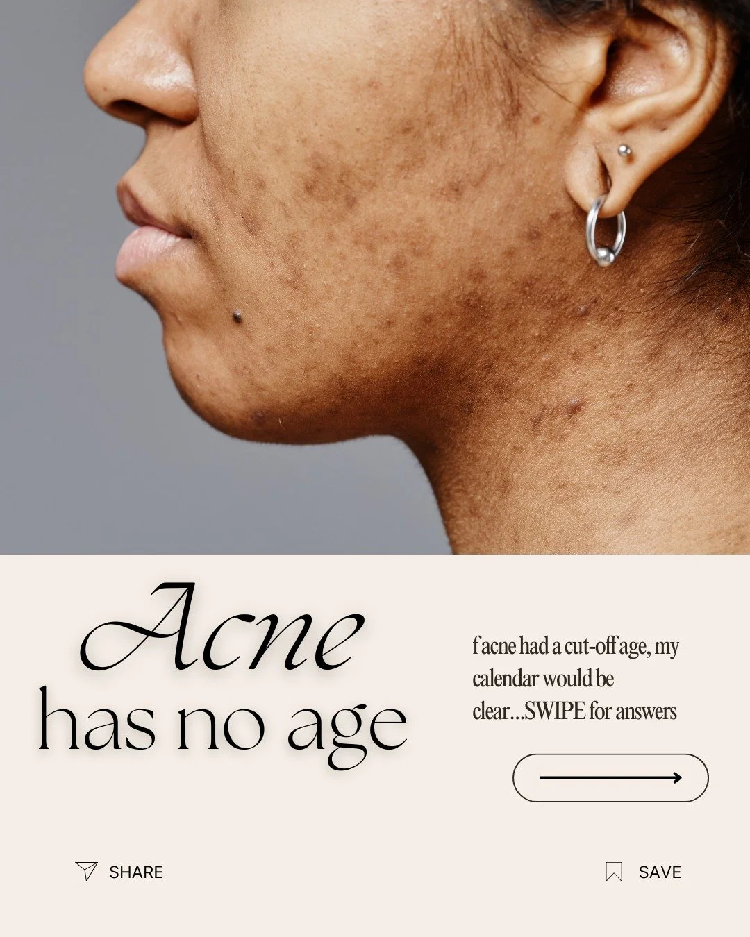 ✨ &ldquo;I thought I&rsquo;d be done with breakouts by now&hellip;&rdquo;
If that sounds like you&mdash;you&rsquo;re far from alone.

Adult acne is real. It&rsquo;s frustrating. And it&rsquo;s not your fault.

Hormones, stress, lifestyle, and even in