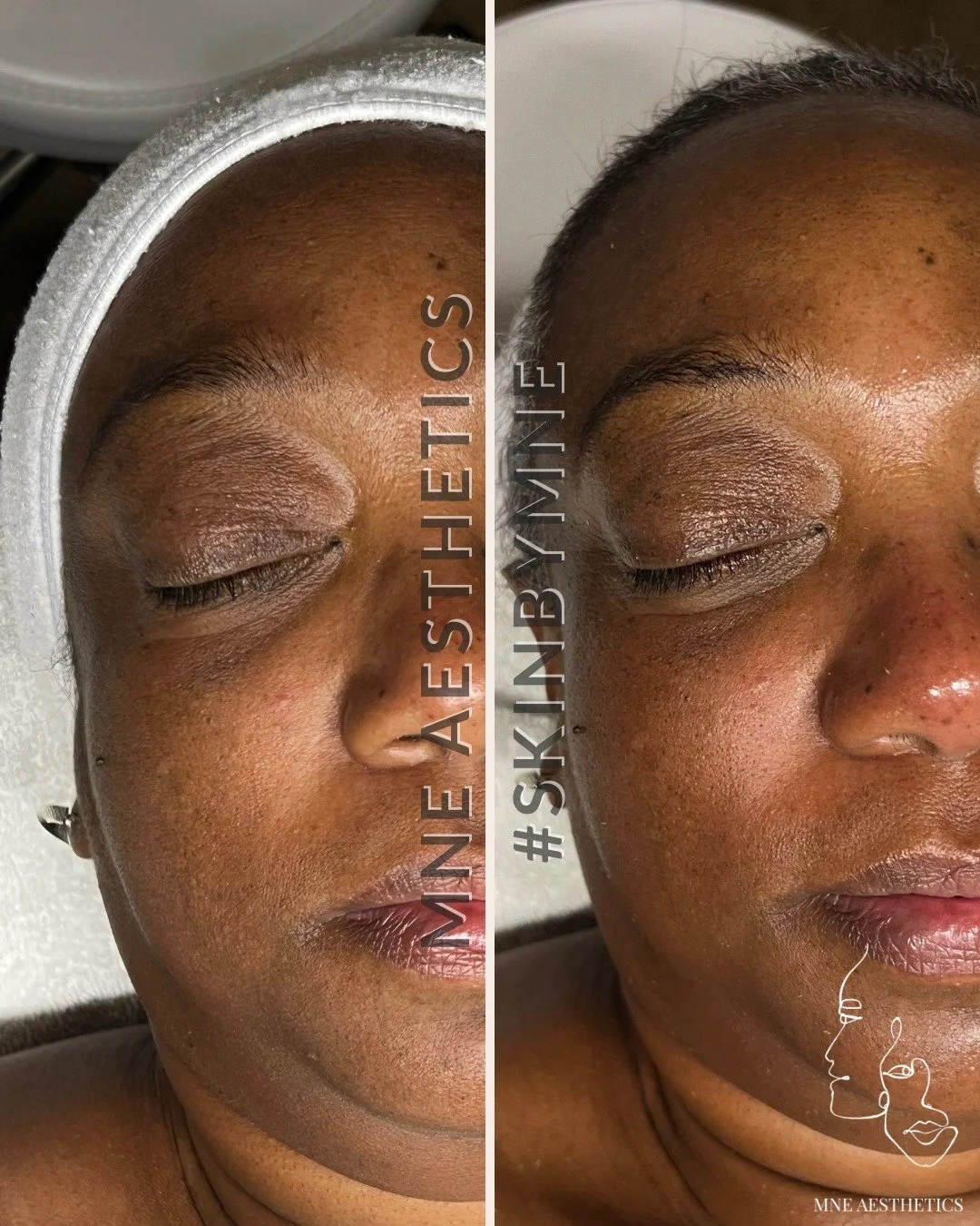 𝙎𝙡𝙞𝙢𝙢𝙞𝙣𝙜 𝙖𝙣𝙙 𝙂𝙡𝙤𝙬𝙞𝙣𝙜
One of my favorite (and most booked!) services is the Signature Facial, featuring a modified sculptural facelift technique. This isn&rsquo;t your average facial&mdash;it&rsquo;s a therapeutic massage that slims 