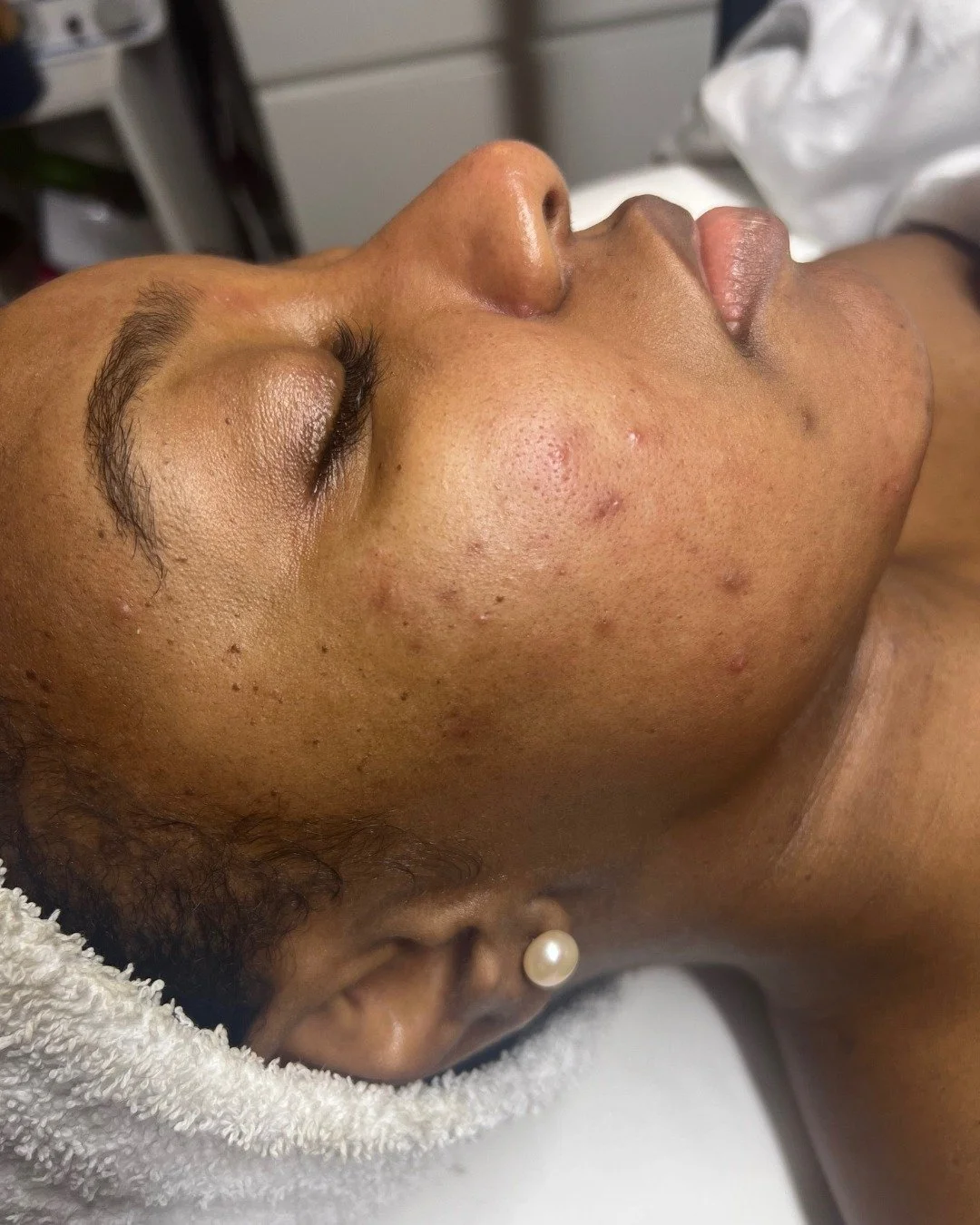 𝘽𝙧𝙚𝙖𝙠𝙤𝙪𝙩𝙨 may fade, but the dark spots 🖤 they leave behind can feel just as stubborn. One of the biggest struggles I see isn&rsquo;t just acne, it&rsquo;s the hyperpigmentation that lingers long after.

✨ The good news? You don&rsquo;t have