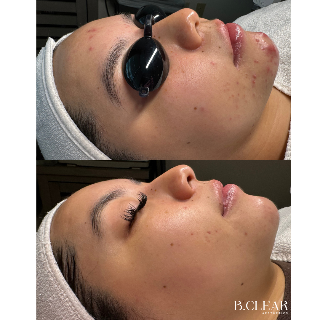 Acne Program Before & After