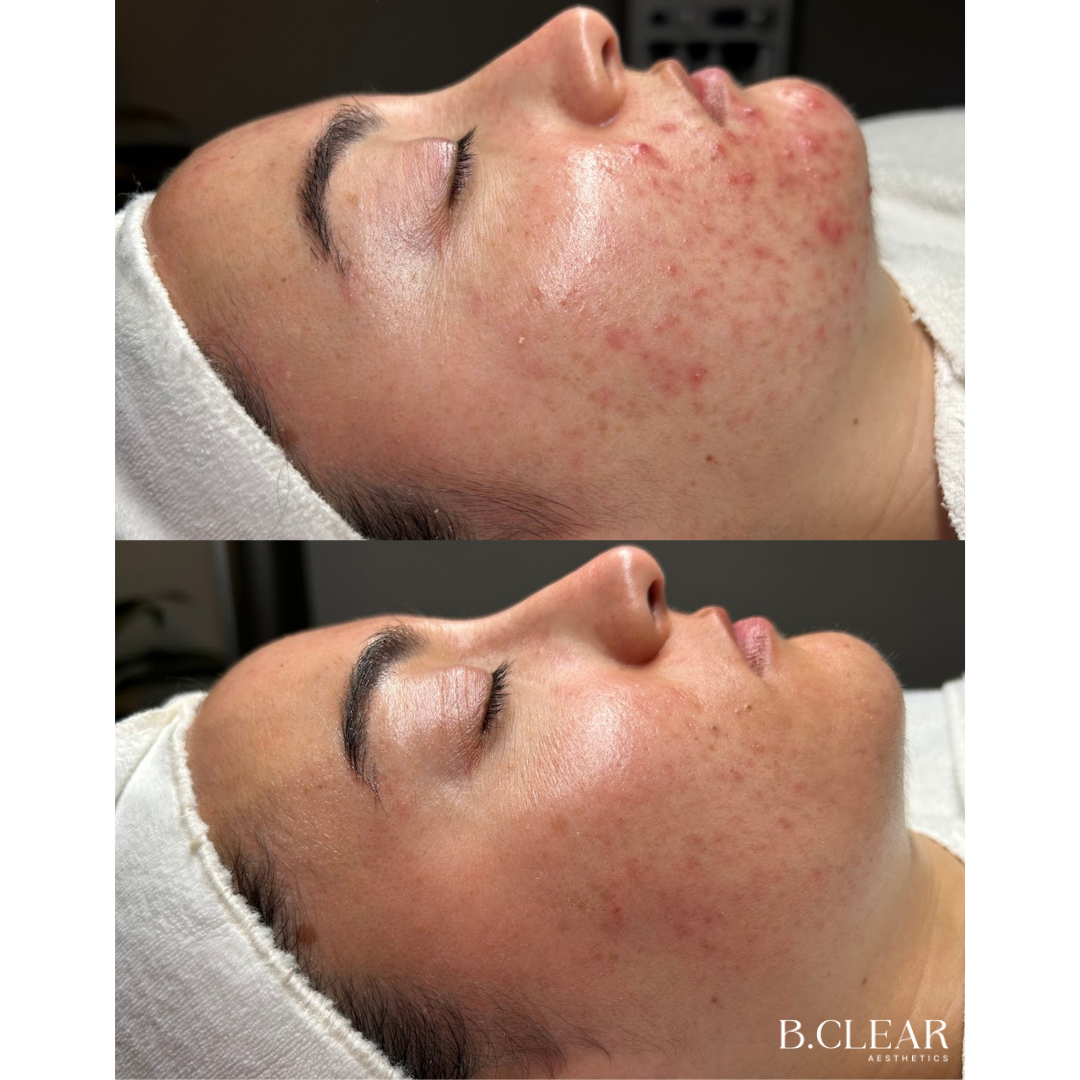 Acne Program Before & After