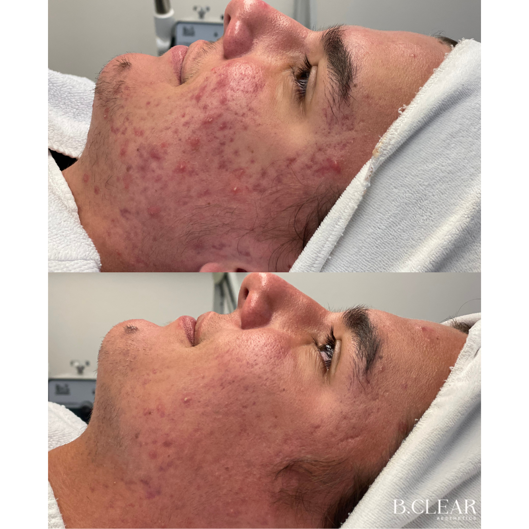 Acne Program Before & After