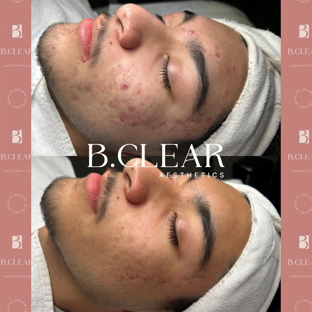 Our client had been struggling with acne for quite some time and was even considering going on Accutane until he found us and began his journey through our Acne Program. 🌿

We created a customized skincare routine tailored to his skin&rsquo;s specif