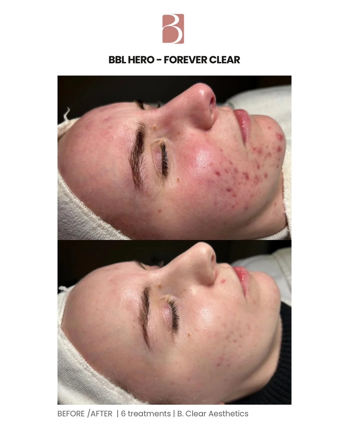 Our Acne Program 🤝 Forever Clear 

What an amazing transformation! 🤍
This client was already dedicated to our Acne Program and following a personalized at-home routine we created for her. Adding BBL HERO Forever Clear to her treatment plan just too