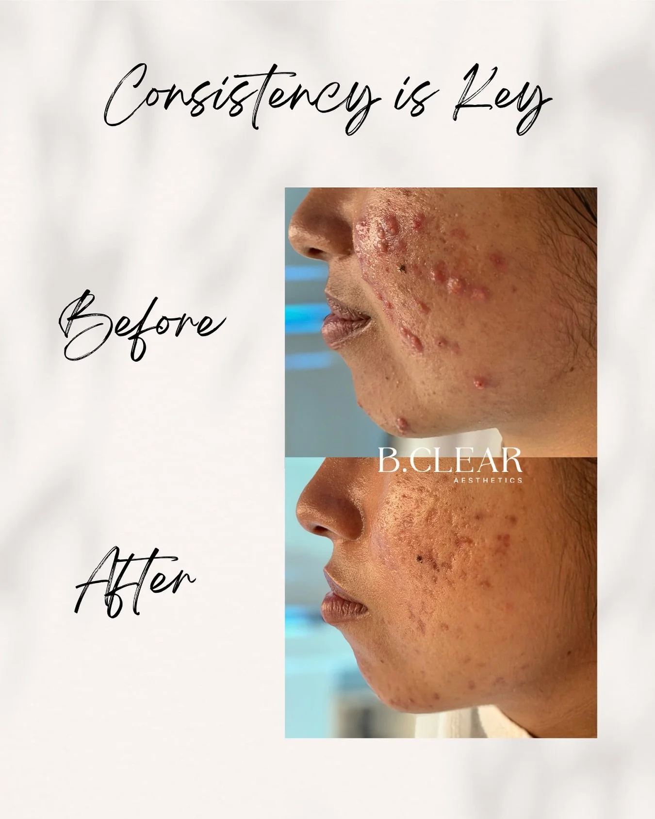 At B. Clear Aesthetics, we&rsquo;re all about getting to the root cause of your acne, not just covering it up. 

When you come in for your Acne Treatment &amp; Consultation, you&rsquo;ll meet with one of our Acne Experts who will walk you through eve