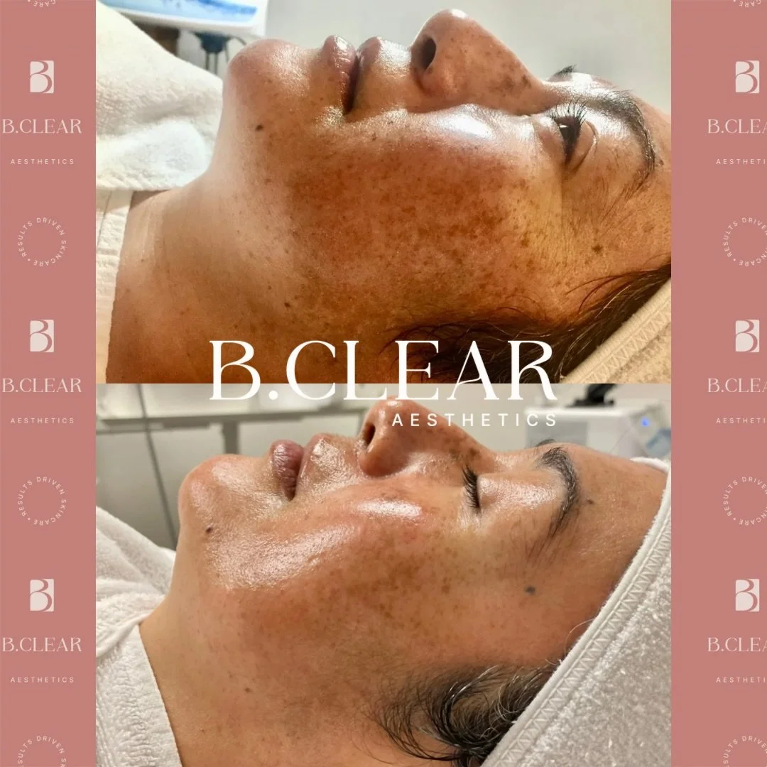 This client of ours was dealing with a lot of sun damage from continuous sun exposure without the use of sunscreen! This is why we always stress the importance of wearing sunscreen every single day 🌤️

She was able to reduce her sun damage with the 
