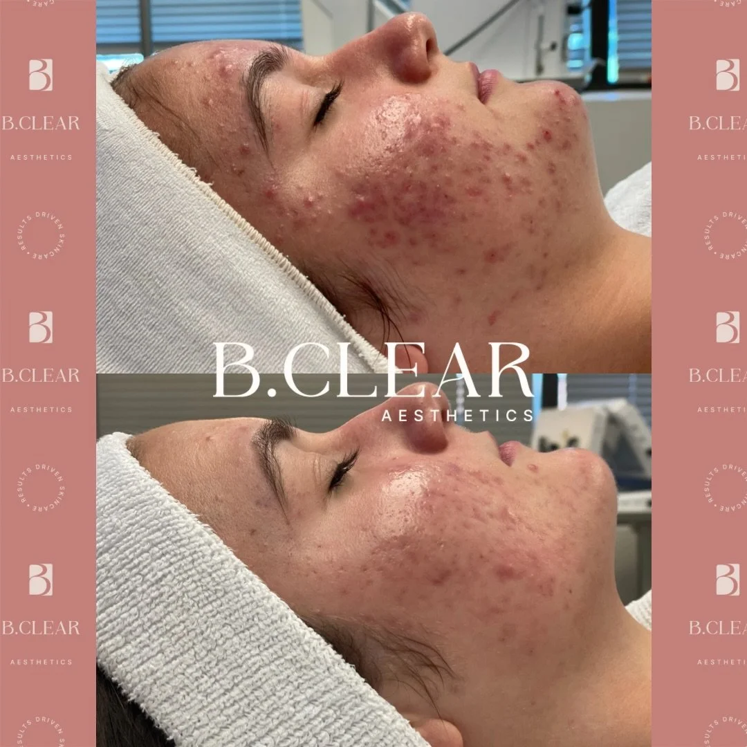 Here&rsquo;s an incredible before and after to bless your feed 

Acne can cause you to feel mentally and emotionally exhausted, but we&rsquo;re here to tell you that you do not have to try and figure out how to clear your skin on your own! We are her