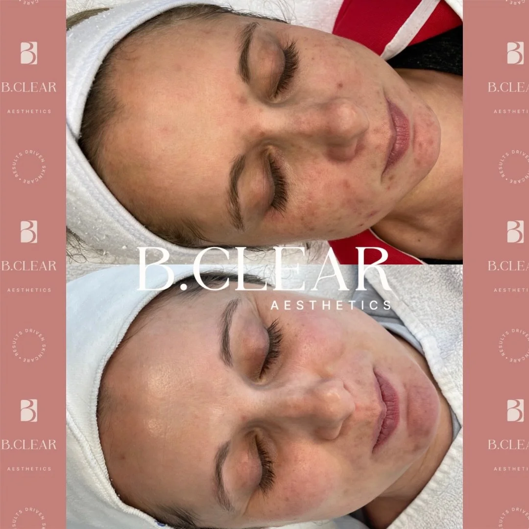 A lovely client transformation ✨

Look at her skin overall - not only has her acne cleared, but her texture, tone, and brightness have improved tremendously! 

We are now focusing on maintaining these results and treating any left over post-acne pigm