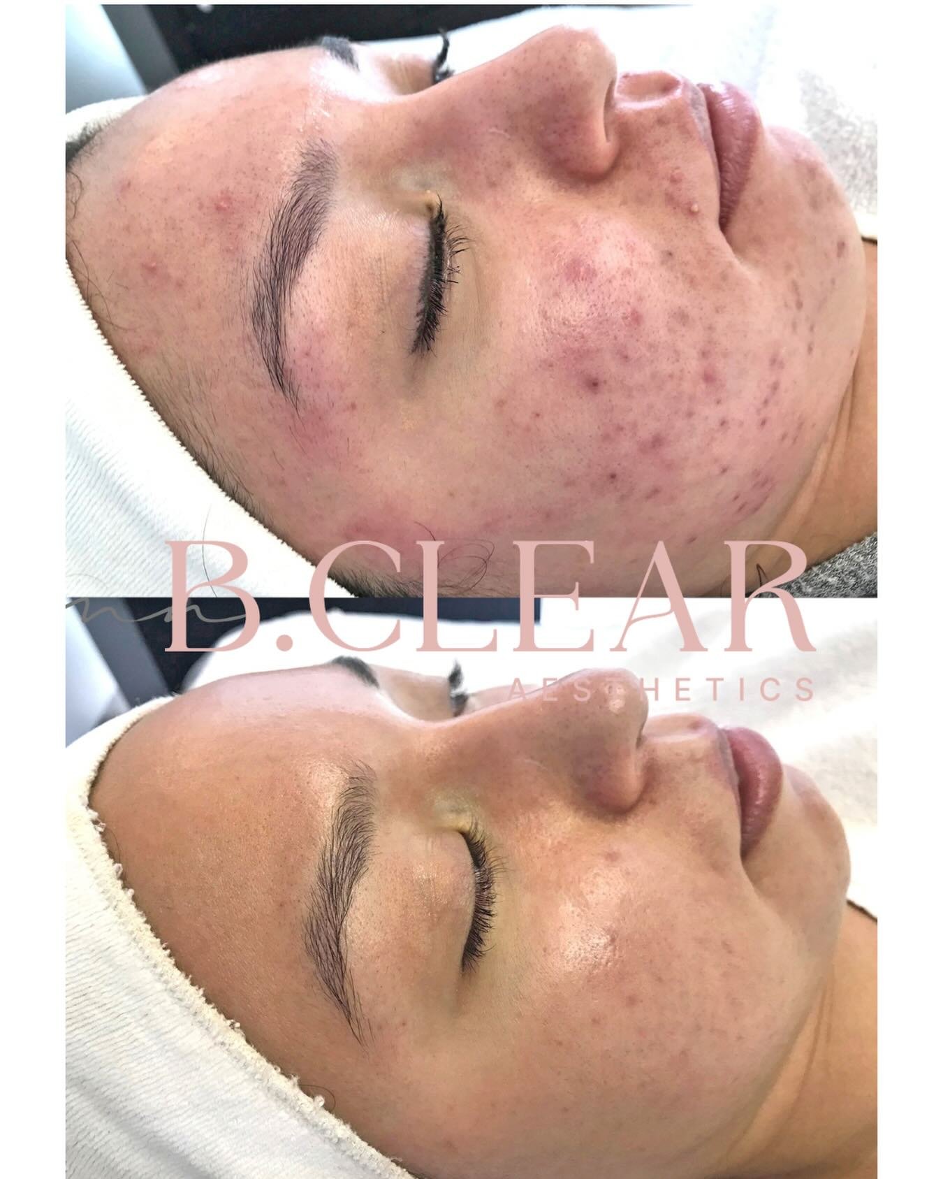 This is one of our favorite transformations. Crystal loves to go hiking and since her skin is clear she has no need to wear any makeup during her sporty activities. Her secret? A consistent skincare routine that keeps her skin glowing and healthy.

S