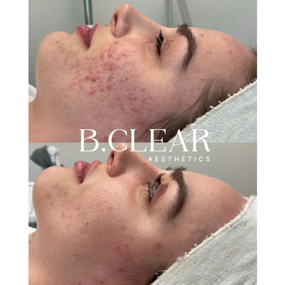 No two faces are the same. That&rsquo;s why every B. Clear acne treatment plan is customized to your skin, lifestyle, and long-term goals. 

This client stayed committed by keeping up with regular appointments and sticking to her at-home skincare rou