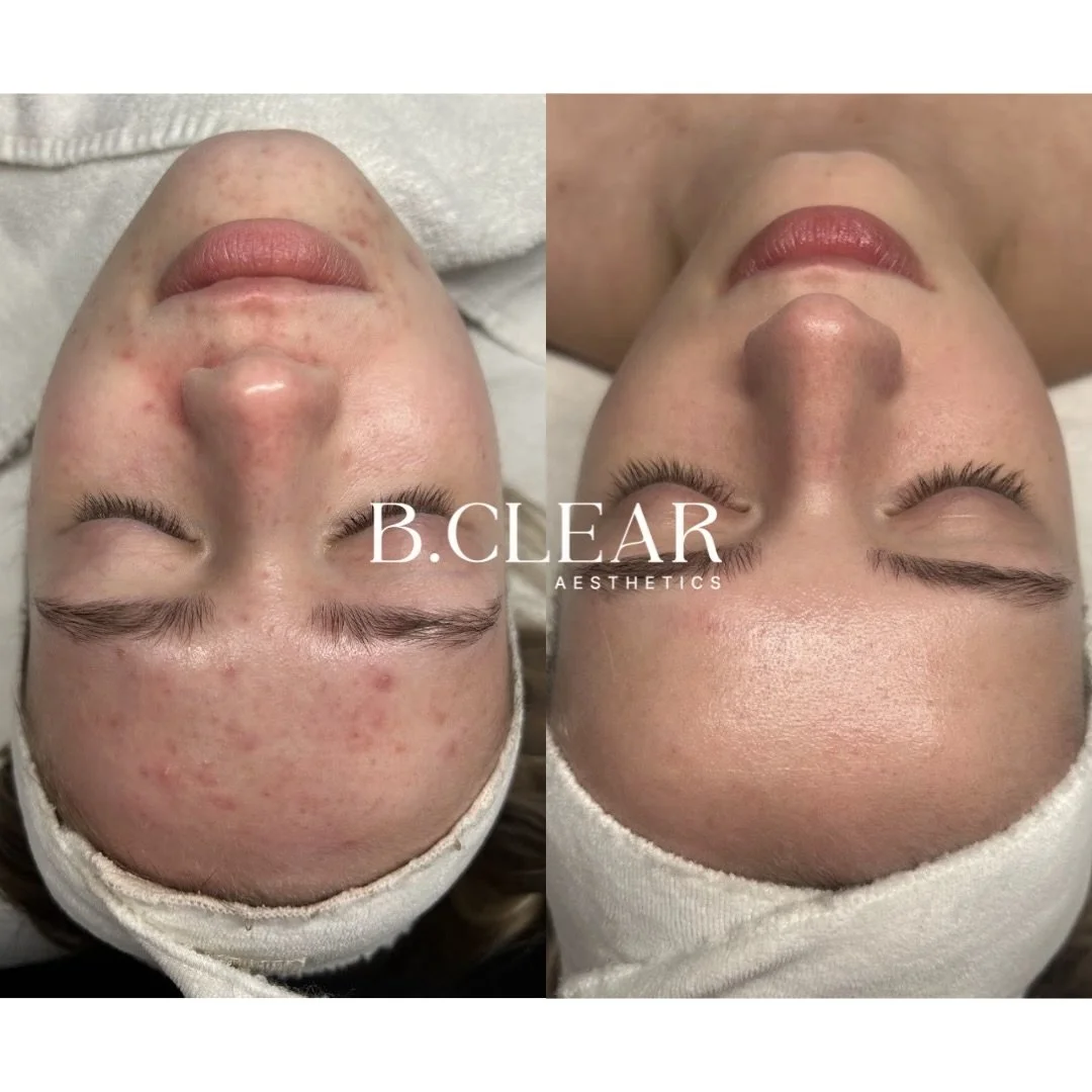 A beautiful transformation ✨ 

Our client was able to achieve clear skin by coming in for consistent treatments, hard work, and patience. 

You can see the difference in her improved tone, texture, and overall appearance. Now her complexion is health