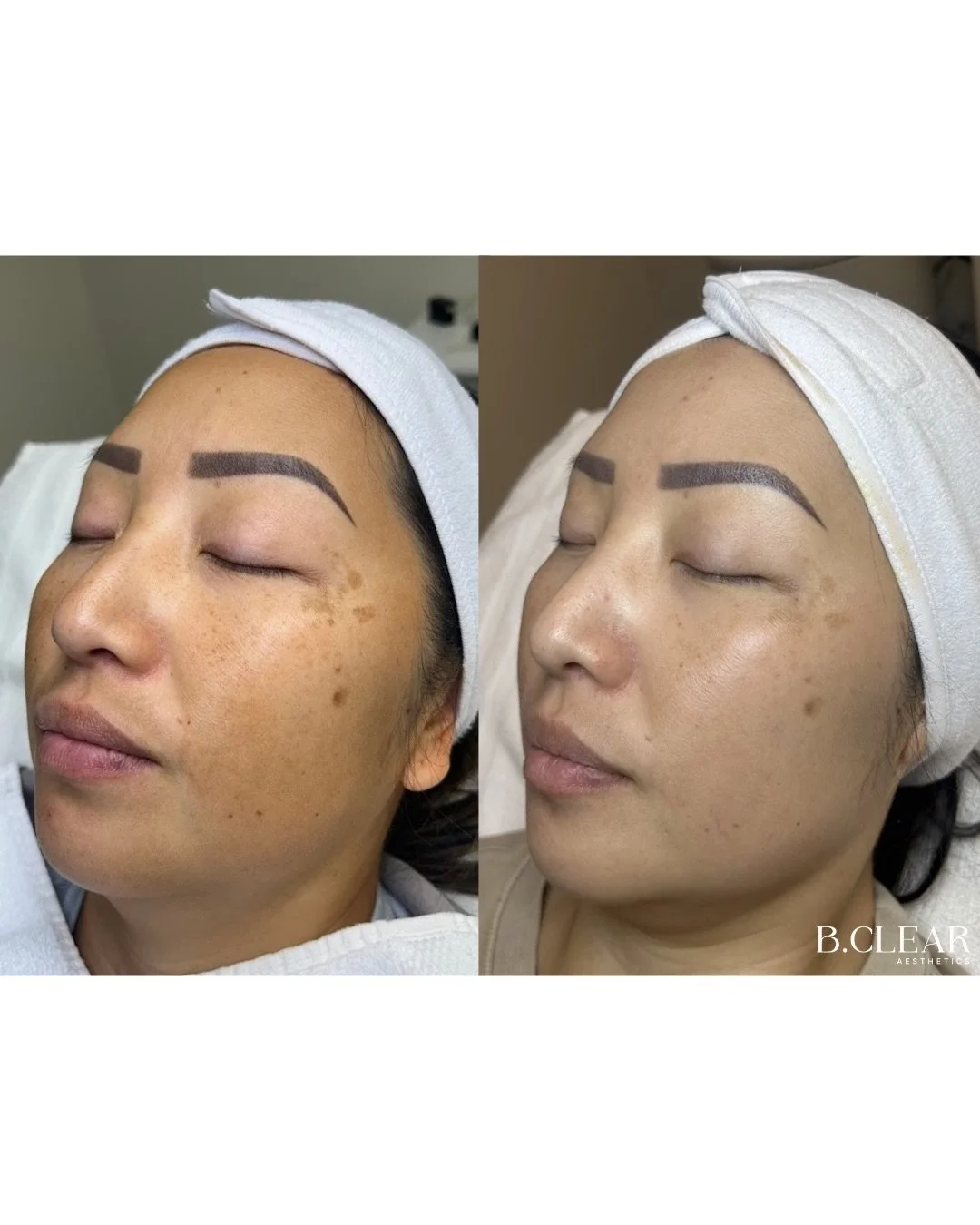 These MOXI results deserve a moment! ✨

Our sweet client came to us wanting to improve pigmentation, sun damage, and overall tone. Here are her incredible results after completing a series of 3 treatments! She also stayed consistent with the professi