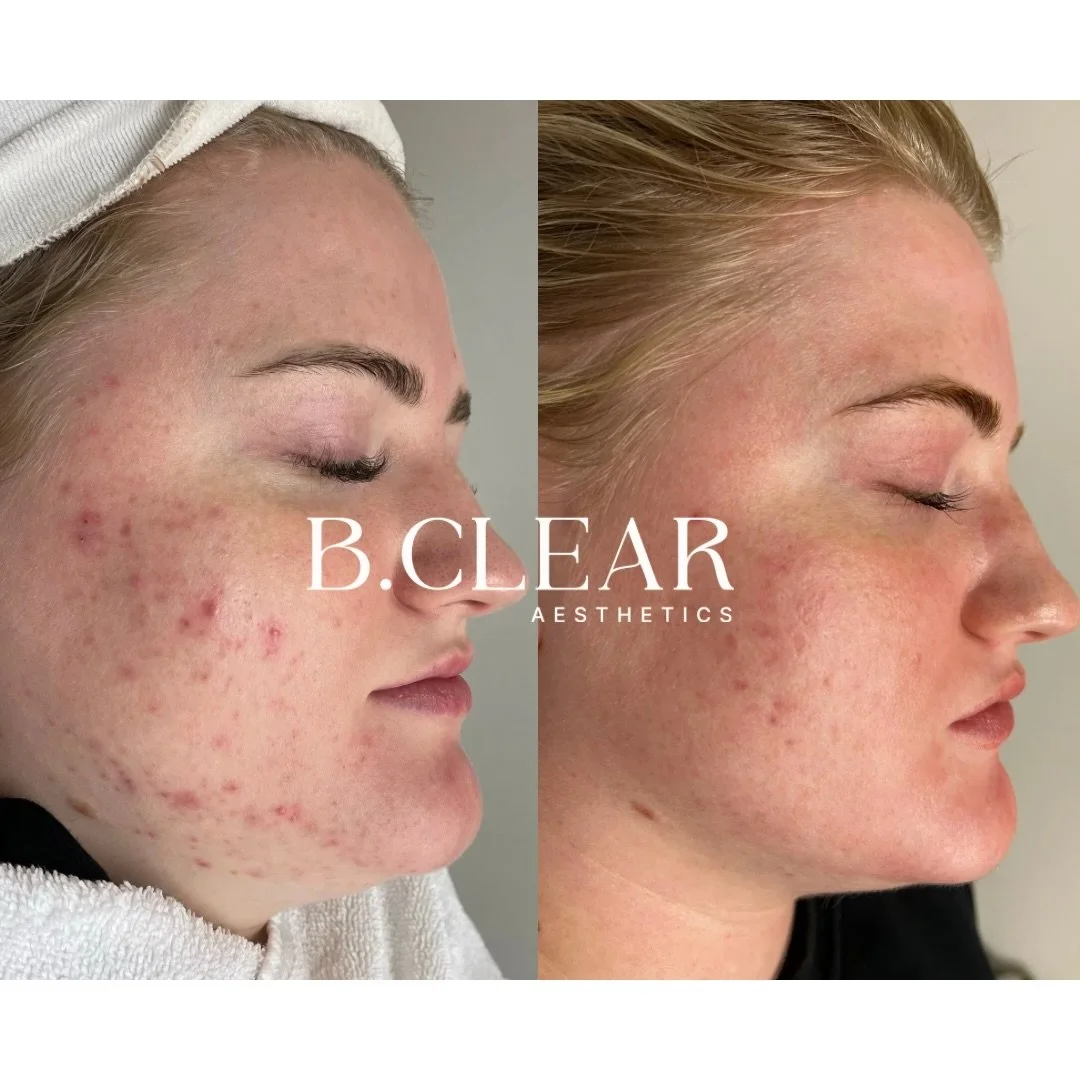 Clear skin doesn&rsquo;t come from one treatment, it comes from consistency. ✨

Acne healing takes time, guidance, and the right routine. With commitment and consistency, you can achieve the skin you&rsquo;ve always wanted. 

If you&rsquo;re struggli