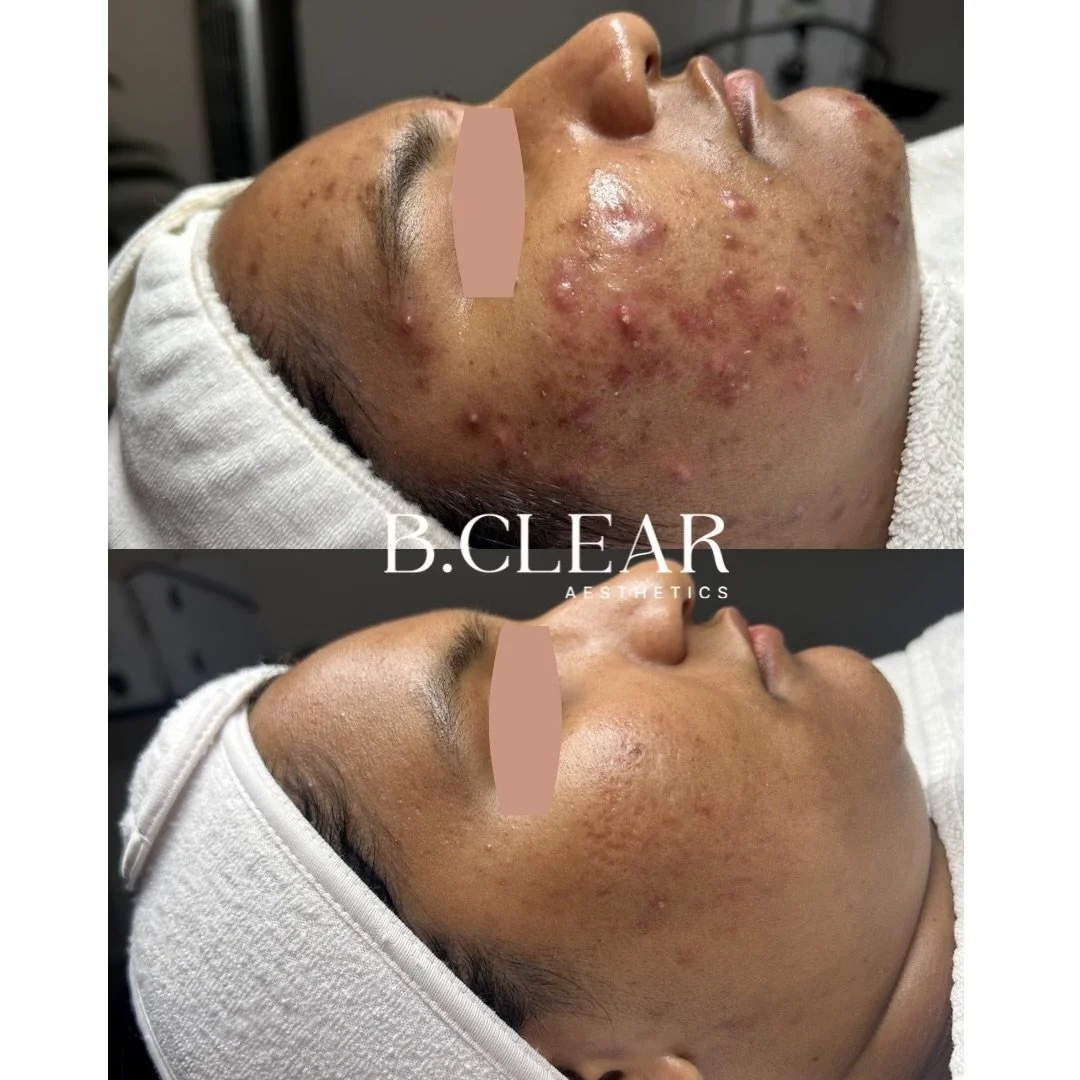 An incredible transformation! ✨

When our client first came in, her skin barrier was so compromised that even moisturizer caused burning.

Instead of rushing into actives, we focused on what her skin truly needed first: barrier repair + deep hydratio